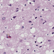 An image of a human brain tissue specimen under a microscope. It displays the telltale spongy holes caused by Creutzfeldt-Jakob disease.